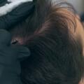 Hair Tattoo For Men: Facts, Success Rate, Before and After Photos